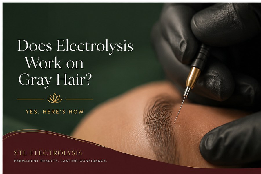 Gray and white hair that responds well to electrolysis where laser is ineffective